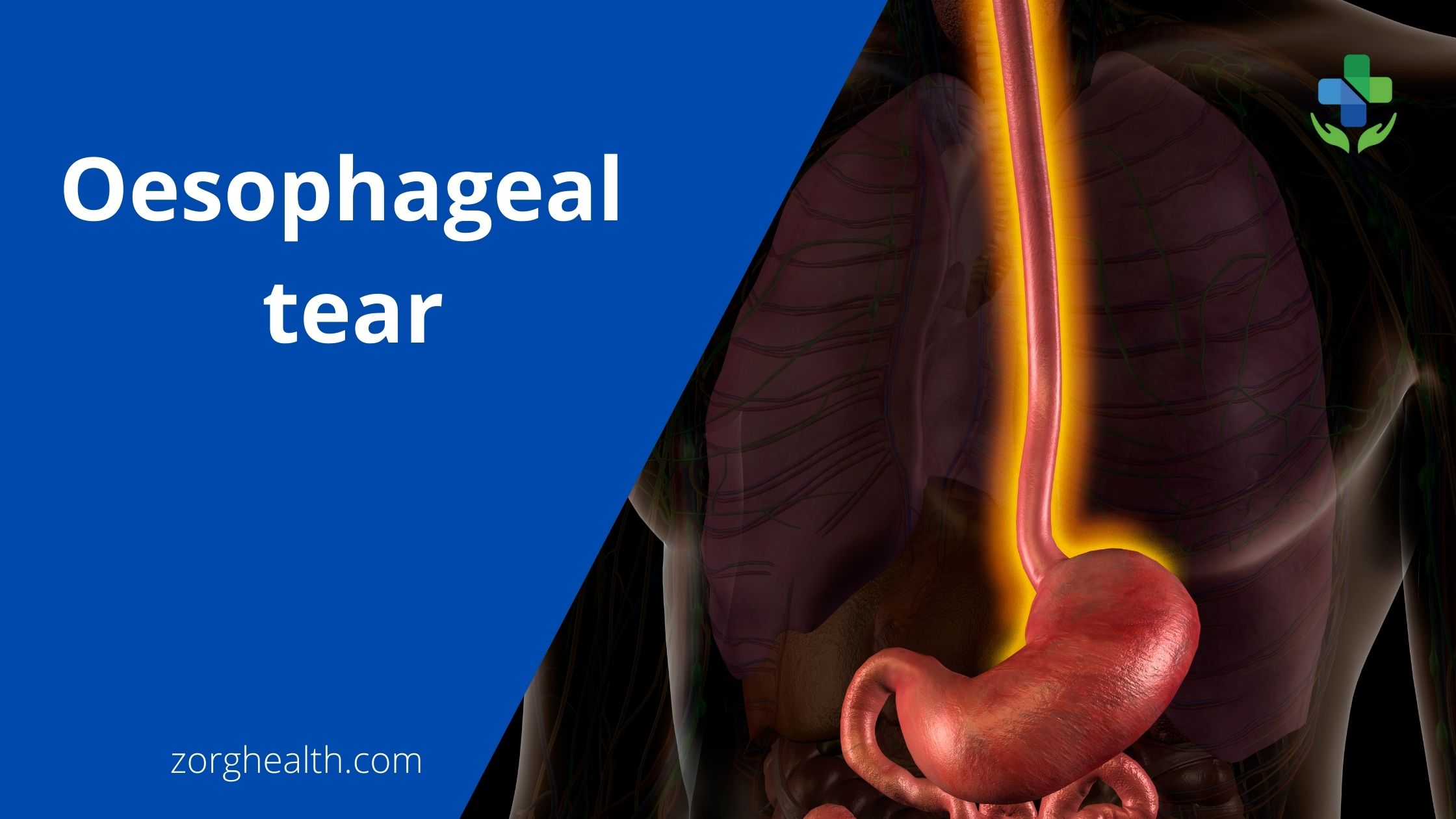 Oesophageal tear