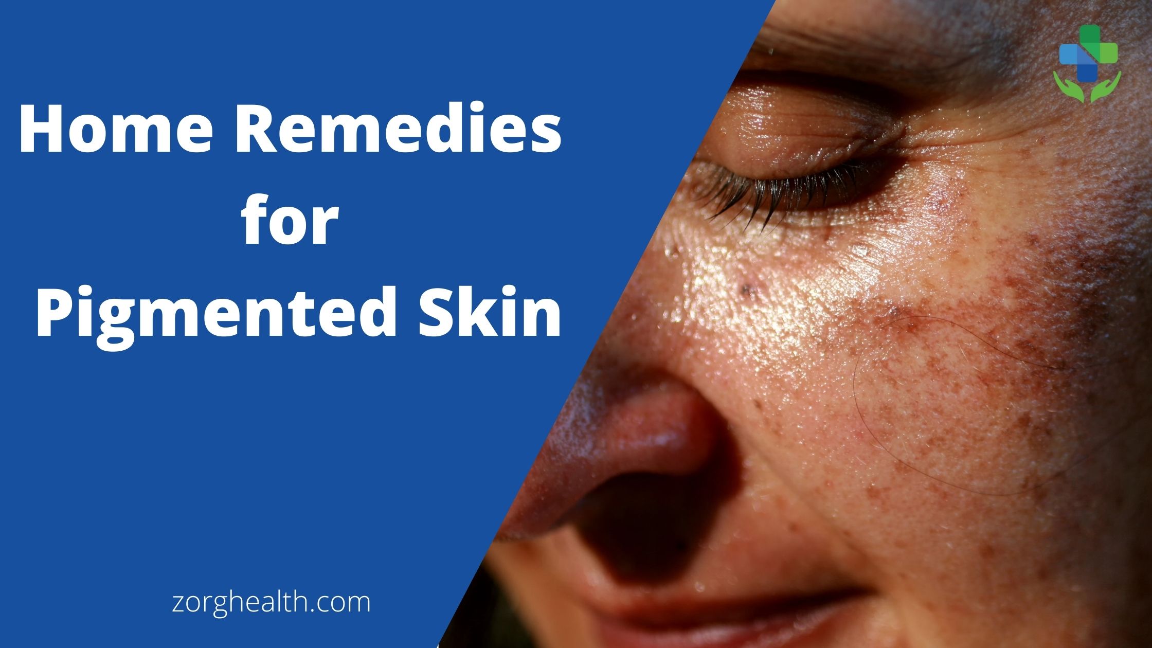 Home remedies for pigmented skin