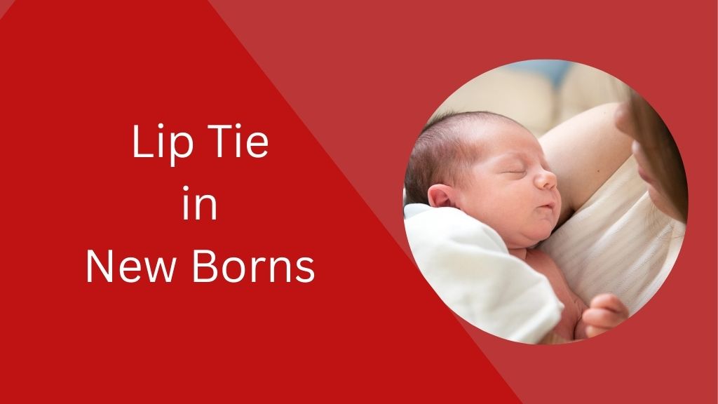 Lip Tie in Newborn